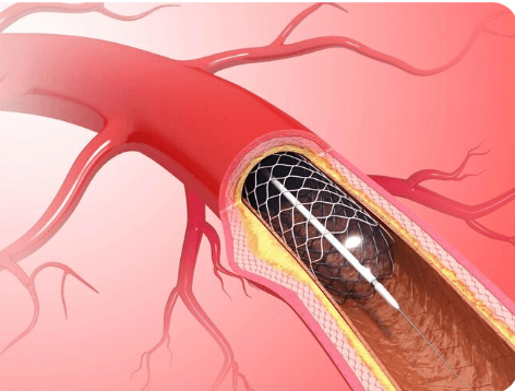 Angioplasty in the Modern Era: Clinical Triage and Risk Mitigation for Healthcare Professionals