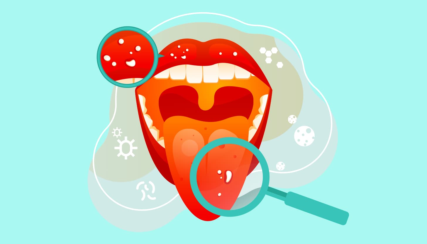 Oral Infections