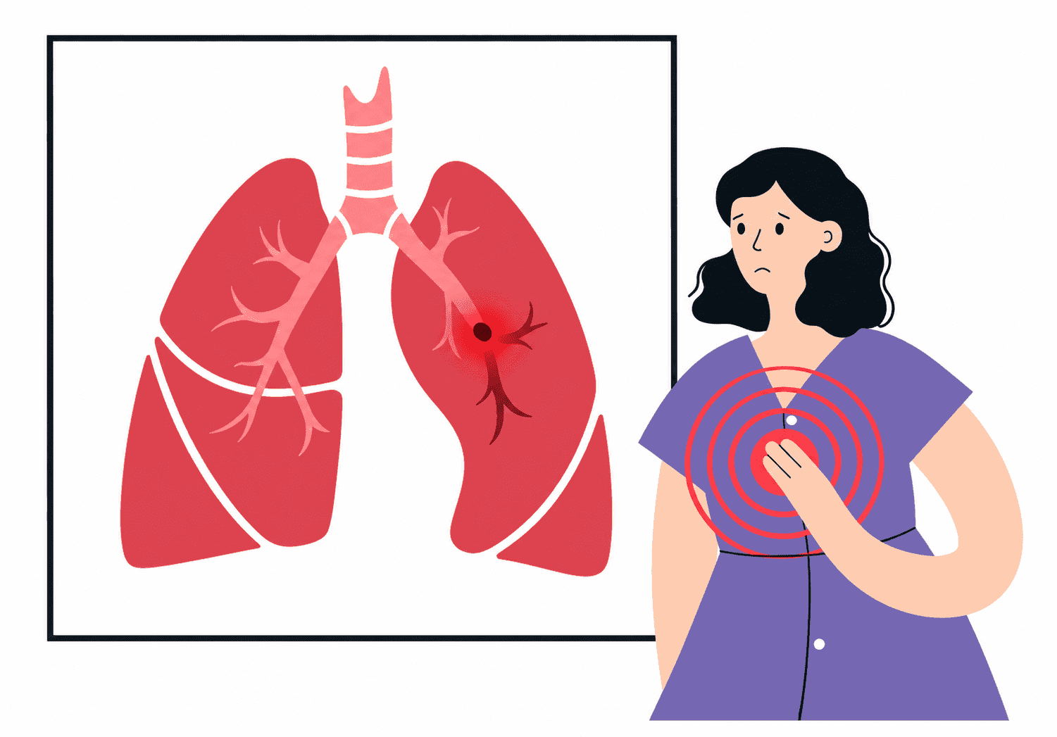 Acute Pulmonary Embolism: Risk Classification and Management