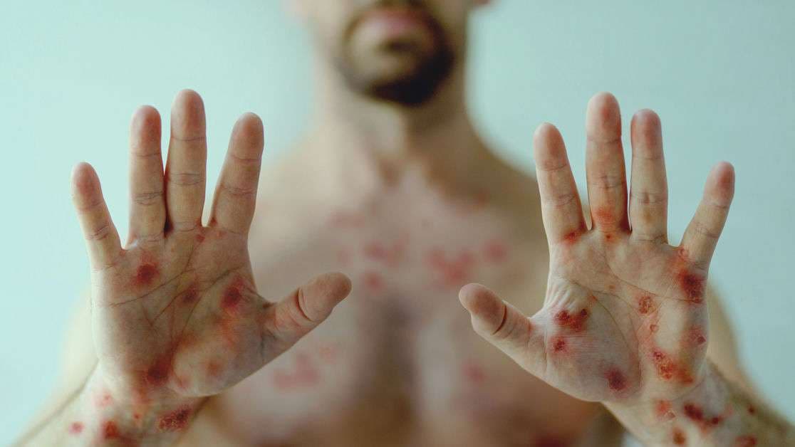 Monkeypox: What Healthcare Workers Need To Know