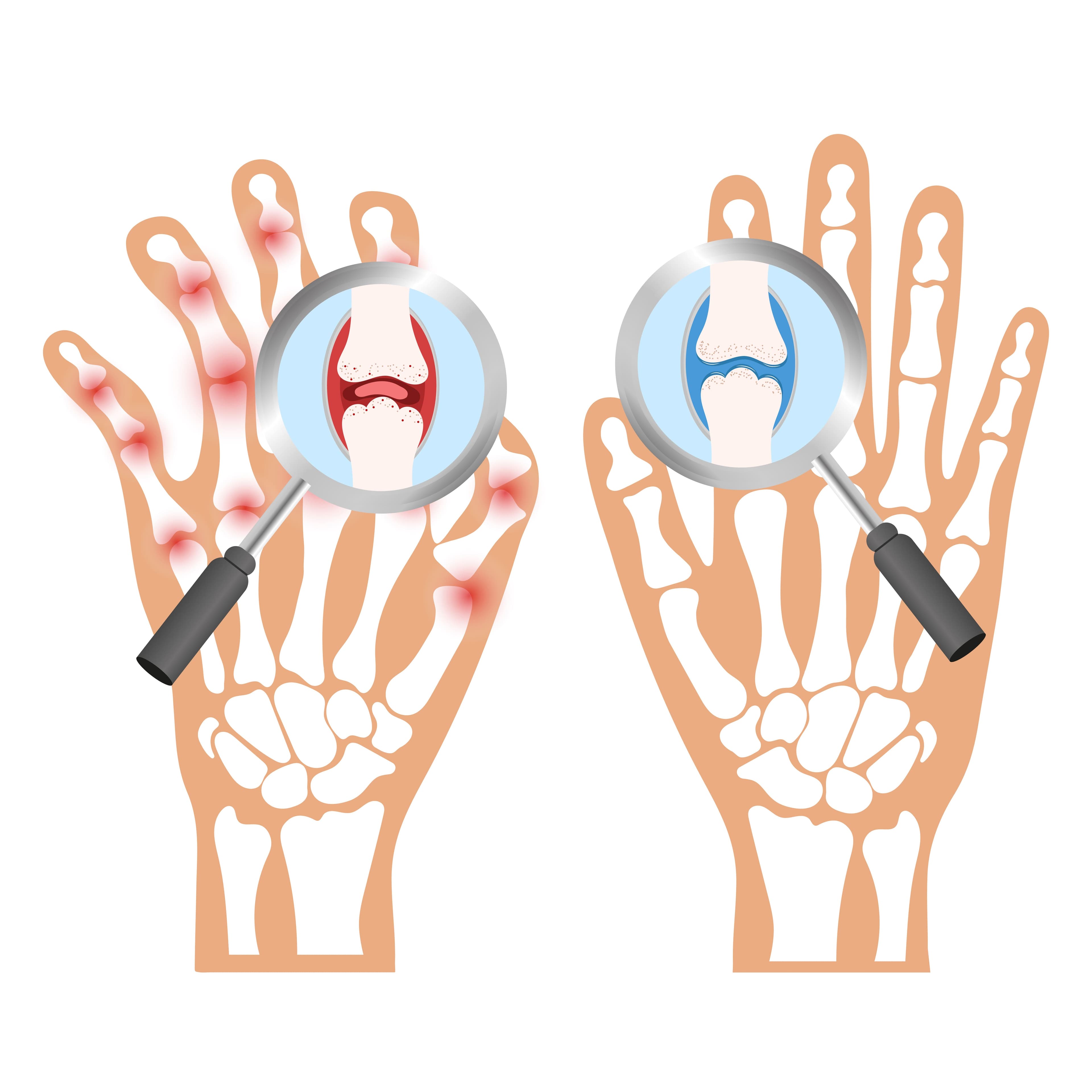 From Inflammation to Liberation: Therapies for Rheumatoid Arthritis Relief