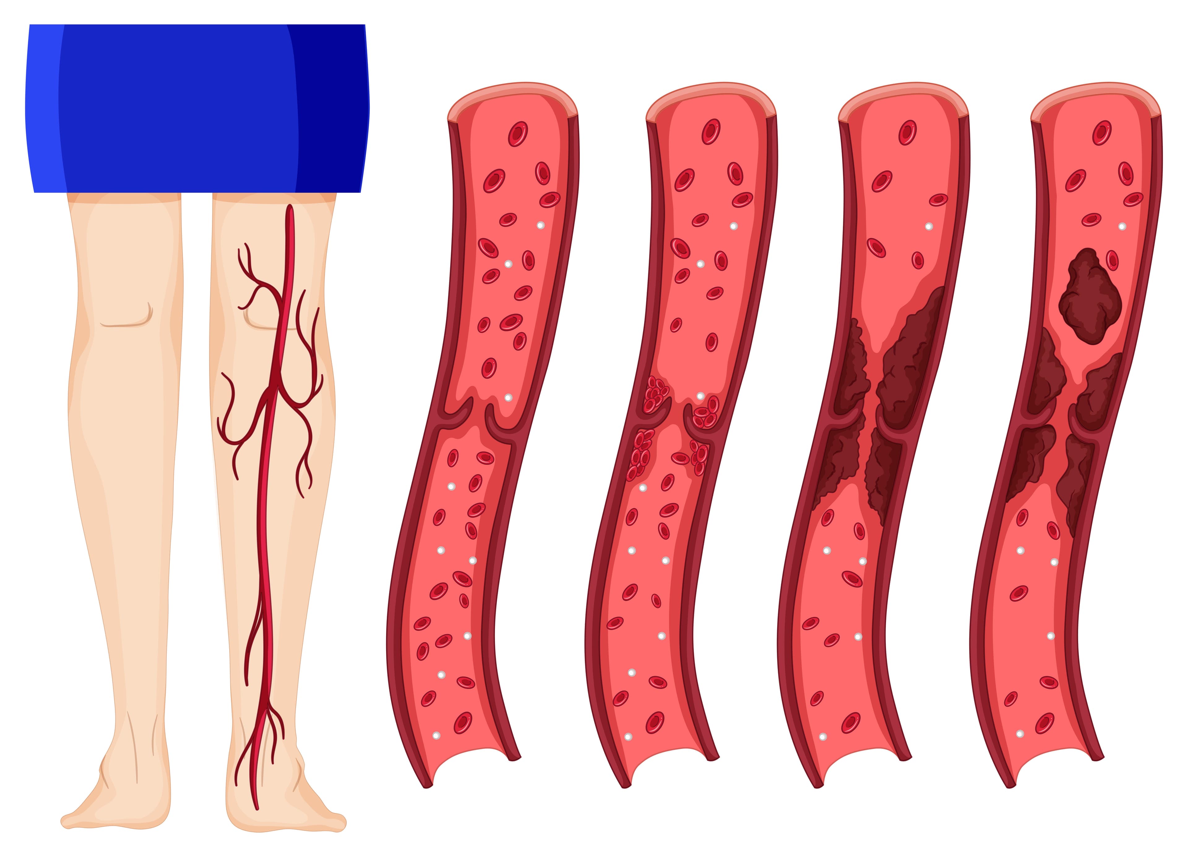 Deep Vein Thrombosis: Evidence-Based Triage, Pharmacotherapy, and PTS Prevention